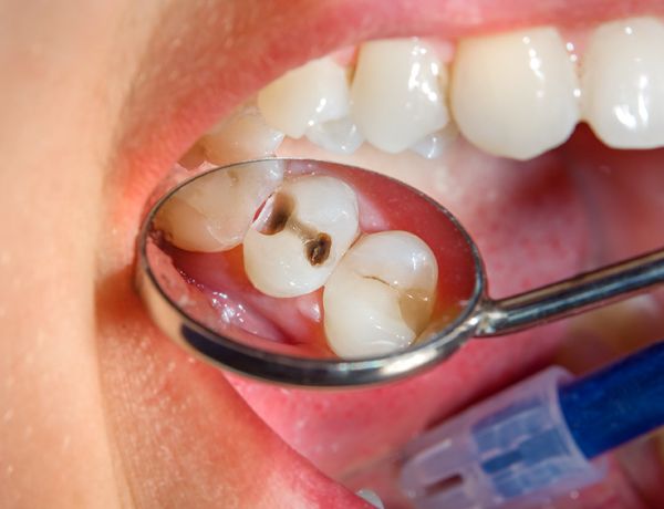 caries contagiosas dentista