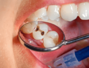 Diente con caries