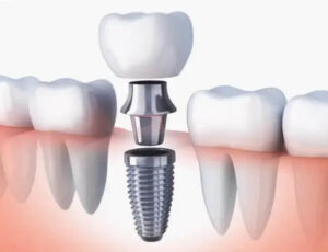cuidar implantes dentales