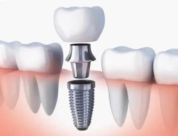 cuidar implantes dentales