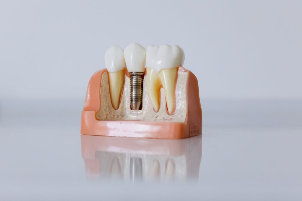 que-son-y-como-se-realizan-los-implantes-dentales