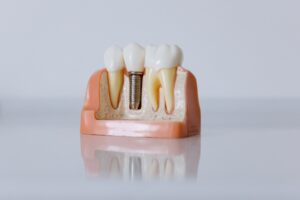 que-son-y-como-se-realizan-los-implantes-dentales