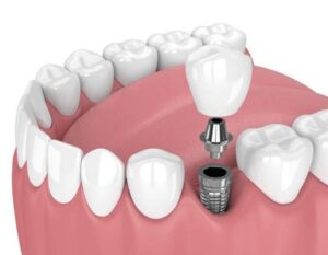 implante dental de titanio