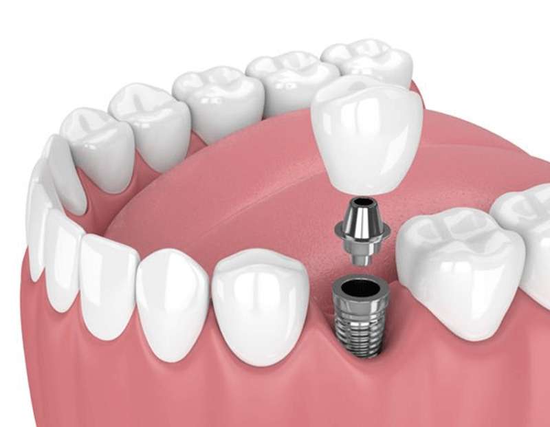 implante dental de titanio