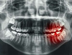 Radiografía sangrado Alzheimer
