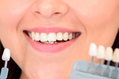 blanqueamiento dental en casa o en el dentista