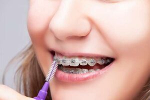 Cómo limpiar los brackets