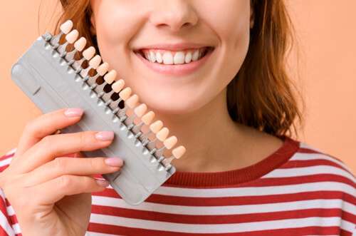 Carillas dentales