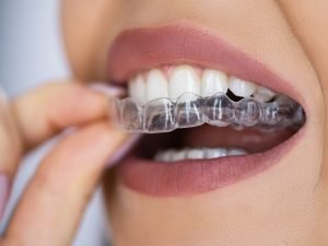 Férula transparente Essix para mantener la posición de los dientes tras ortodoncia