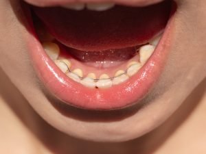 Retenedor fijo colocado en la parte interna de los dientes inferiores