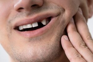 Agenesia-dental