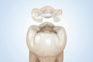 inscrustació dental